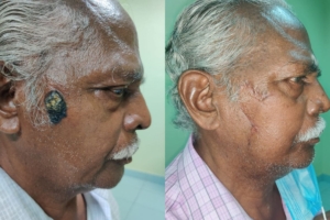Cancer & Plastic Surgery