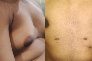 Gynecomastia