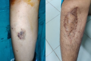 Vascular Malformations