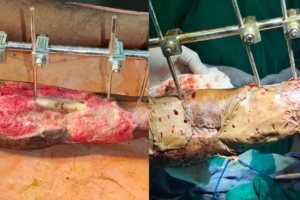 Fracture Bone Exposed Wound