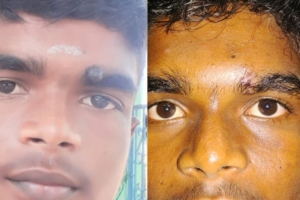 Mole In Eyebrow